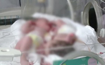 Mama siamezelor născute în Constanţa nu le-a văzut niciodată pe micuţe
