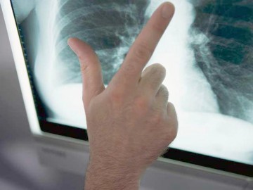 Strategie de Control a Tuberculozei în România: Schimbare a modului în care este decontat tratamentul