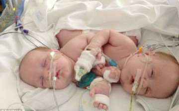 Doi bebeluşi siamezi yemeniţi, separaţi cu succes în urma unei intervenţii chirurgicale în Iordania