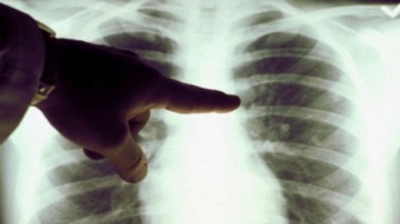 Alertă epidemiologică în județul Tulcea. 100 de persoane testate pentru tuberculoză