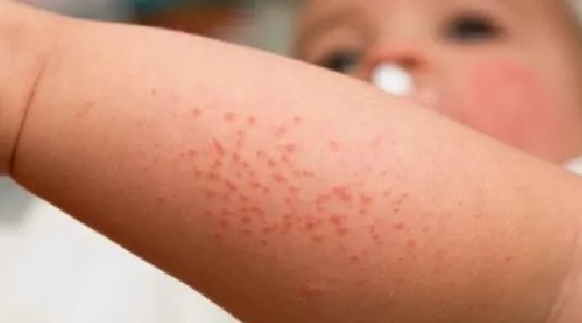 Ce este de făcut în dermatita atopică