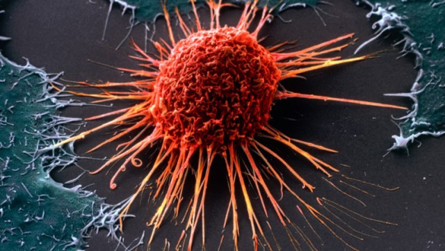 Pacienți cu cancer limfatic vindecați cu ajutorul virusului HIV
