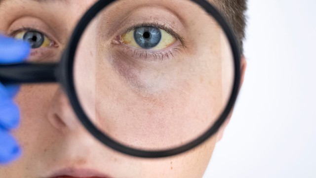 Icterul: de ce apare, simptome, tratament