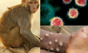 Încă un caz de variola maimuței în România: pacientul este bărbat