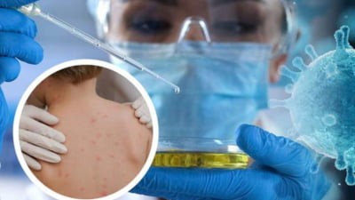 OMS: Variola maimuţei se instalează în ţări non-endemice: 1.000 de cazuri în 29 de ţări