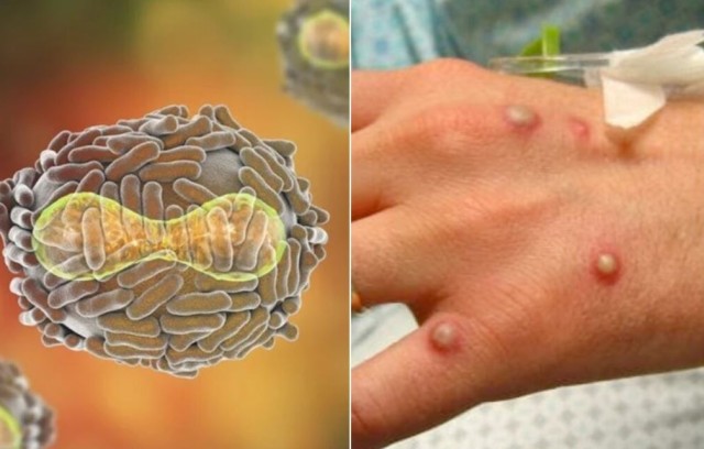 Ministerul Sănătăţii: Al treilea caz de variola maimuţei a fost diagnosticat în România