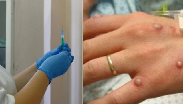 Primele cazuri de variola maimuței, în Emiratele Arabe Unite şi Slovenia