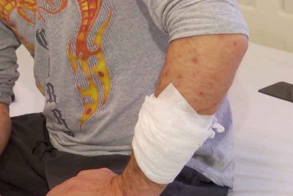 Două noi cazuri de variola maimuţei, confirmate în România