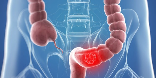 Cum afli dacă ai polipi pe colon și în ce situații se pot transforma în cancer