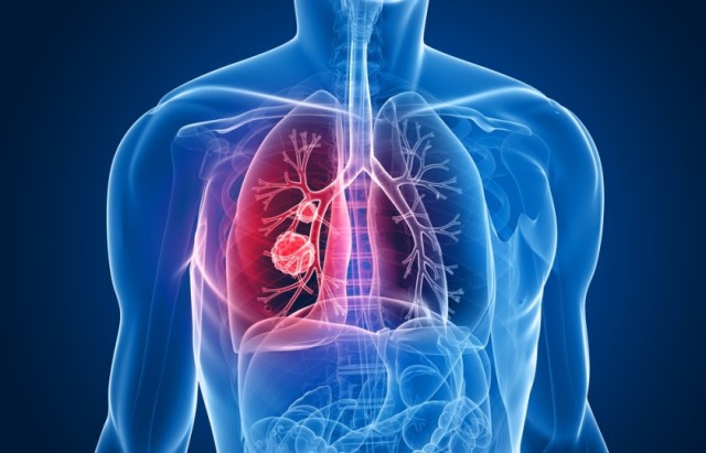 Studiu: 70% dintre românii decedați la doi ani de la diagnosticarea cu cancer pulmonar aveau între 60 și 70 de ani