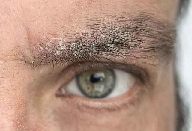 Dermatita seboreică: simptome, cauze, metode de tratament