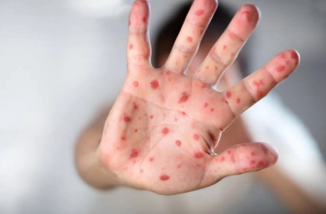 O boală extrem de contagioasă reapare într-o țară din Europa după 40 de ani