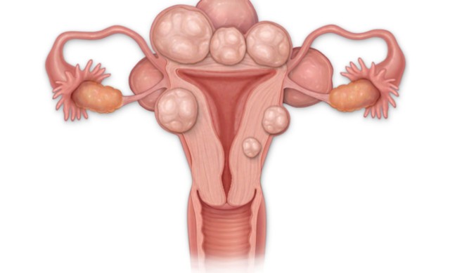 Atenție la fibromul uterin! Poate da complicații grave