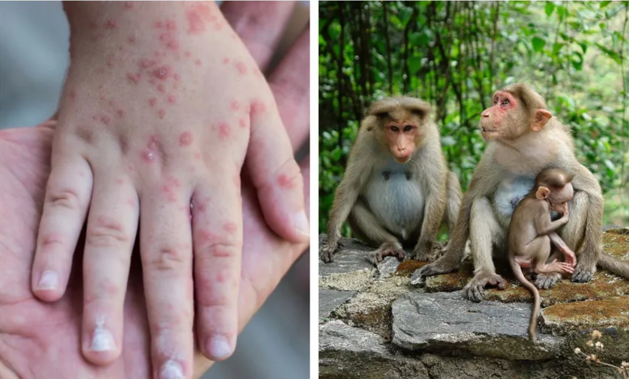 New York a declarat variola maimuţei urgenţă de sănătate publică