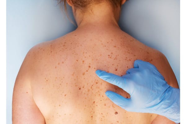 Studiu: Românii sunt informați despre cancerul de piele, dar nu obișnuiesc să meargă la medicul dermatolog