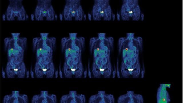 Rezultate uluitoare pentru un studiu efectuat pe pacienți cu cancer rectal