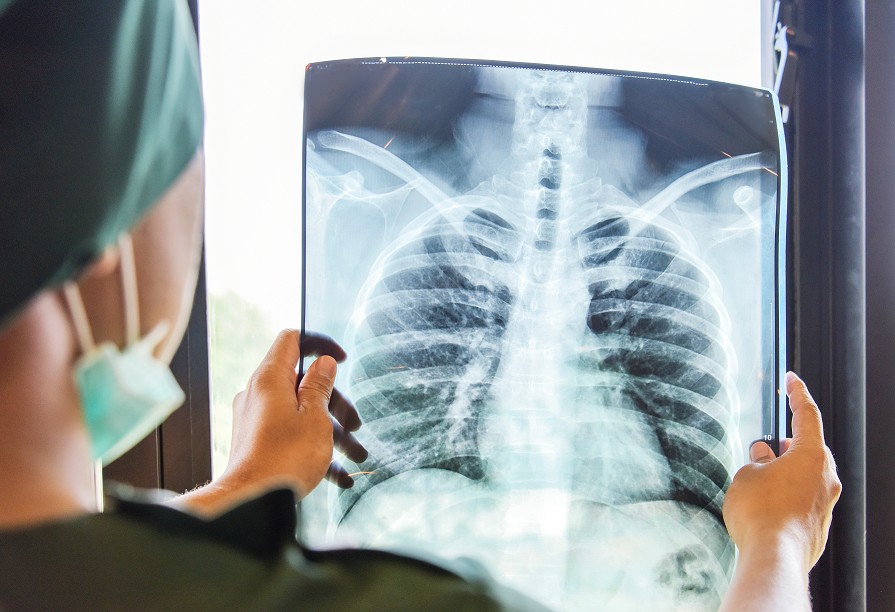 Val neobișnuit de pneumonii la copii în România. Medicii trag un semnal de alarmă