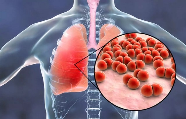 După 50 de ani apare vaccinul împotriva virusului care provoacă pneumonia