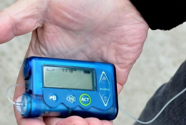 Premieră: O pacientă care suferă de 14 ani de diabet a primit o pompă cu insulină