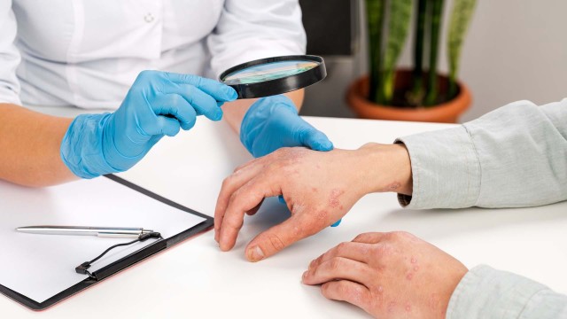 Psoriazis: cauze, simptome și tratament