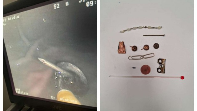 Medicii au scos din stomacul unui pacient piuneze, cuie, agrafe și un termometru cu mercur