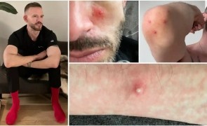 Director al fundației lui Soros, infectat cu variola maimuței!