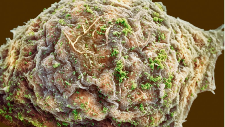 Un bărbat infectat cu HIV s-a vindecat după ce a primit un transplant de măduvă