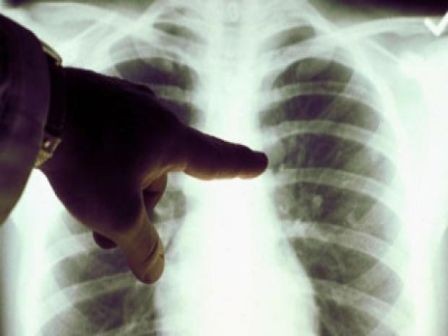 România îşi propune eradicarea tuberculozei până cel târziu în anul 2035