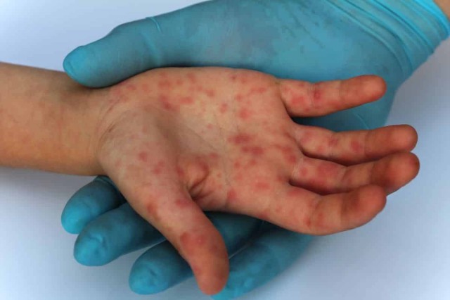 Două noi cazuri de variola maimuţei, confirmate în România