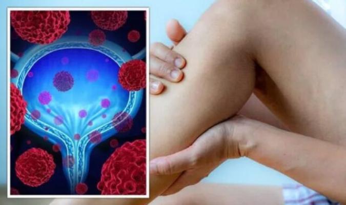 Picioarele umflate ar putea semnala stadiul „cel mai sever” al cancerului de vezică urinară
