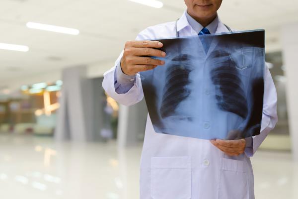  Cercetătorii au descoperit noi factori de risc, de natură genetică, pentru fibroza pulmonară idiopatică