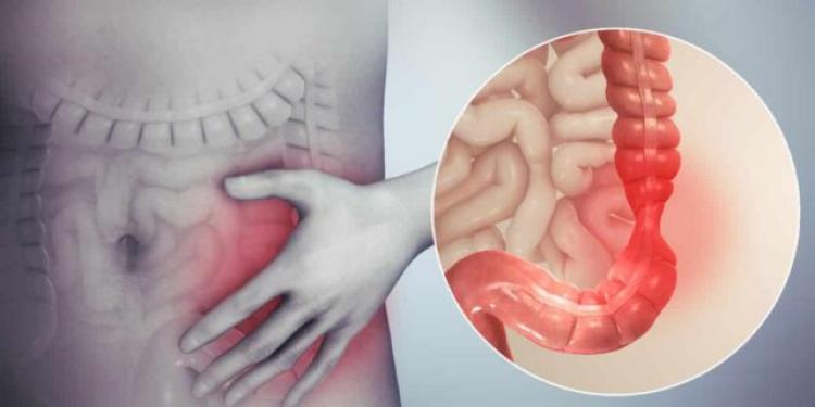 Oncolog: Cancerul de colon debutează asimptomatic