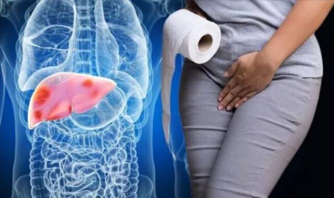 Culoarea urinei care ar putea semnala leziuni hepatice ireversibile