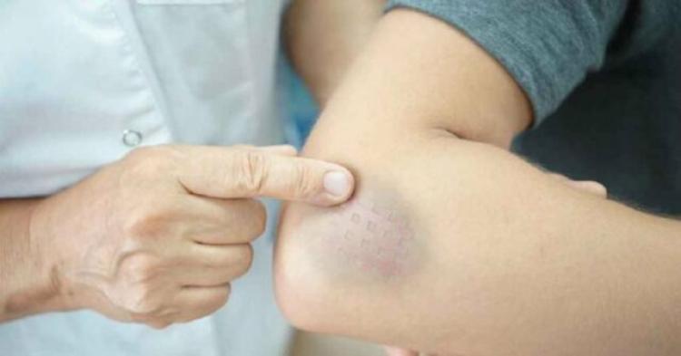 De la ce îți apar vânătăi peste noapte. Pot fi un semn de alarmă