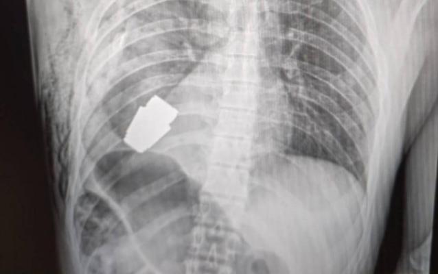 Premieră: Medicii militari ucraineni au scos o grenadă neexplodată din corpul unui soldat 