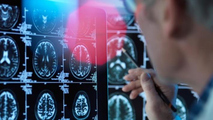 Premieră: Experții chinezi anunţă primul caz de Alzheimer la un pacient de 19 ani