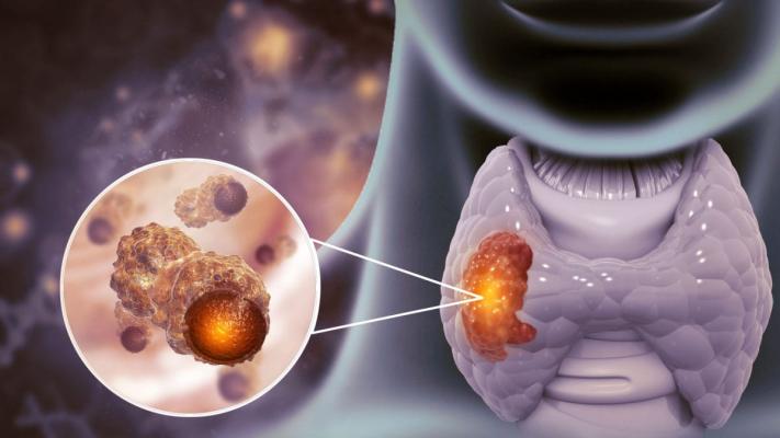 Cancerul tiroidian anaplazic: cauze, simptome și tratament
