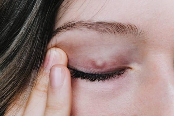 Află totul despre chalazion: ce este și cum să-l tratezi