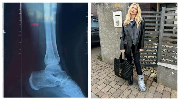 ”Ar trebui să îmi iau un baston sau cârjă” Andreea Bănică, cu piciorul imobilizat din cauza unui accident banal
