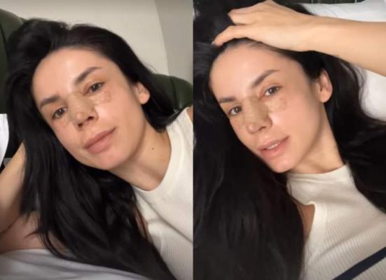 Ioana Grama, adevărul despre operația de rinoseptoplastie suferită