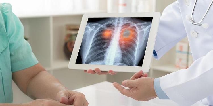 Un algoritm poate prezice cancerul pulmonar cu 6 ani înainte de apariție