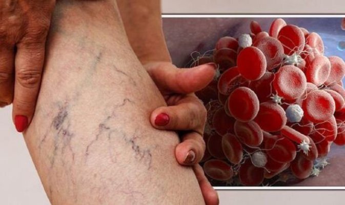 Cinci semne comune de avertizare ale cheagurilor de sânge