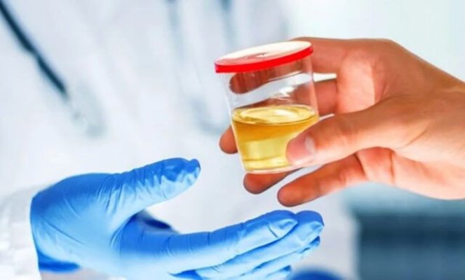 Urina poate semnala că ceva nu este în regulă cu sănătatea ta. La ce trebuie să fii atent