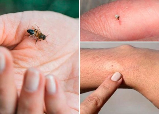 Alergia la veninul de albine poate pune viața în pericol! Medic, despre măsurile de prim ajutor