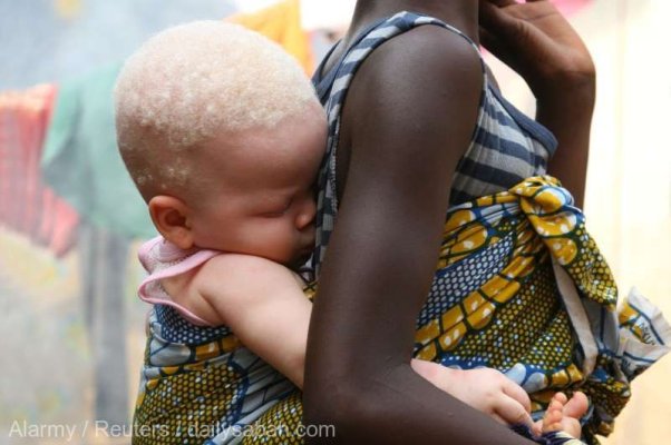 Un val misterios de sechestrări de persoane cu albinism a zguduit Madagascarul