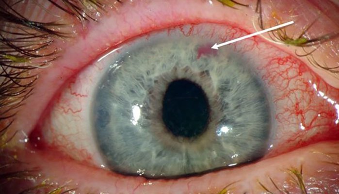 Medic: Netratat, glaucomul poate duce la orbire