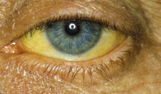 Hepatita A: semnul care apare în ochi şi alte 8 simptome la care trebuie să fii atent