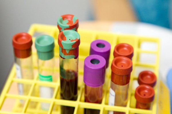 Ce afecţiuni grave poate ascunde fibrinogenul crescut. Valorile normale în funcţie de vârstă