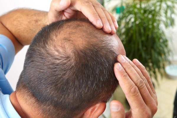Un plasture ce poate fi aplicat fără durere pe scalp va face să dăm uitării problemele legate de căderea părului