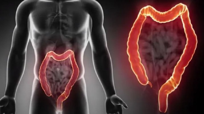 Medici: Aceste băuturi sunt legate de cancerul colorectal timpuriu